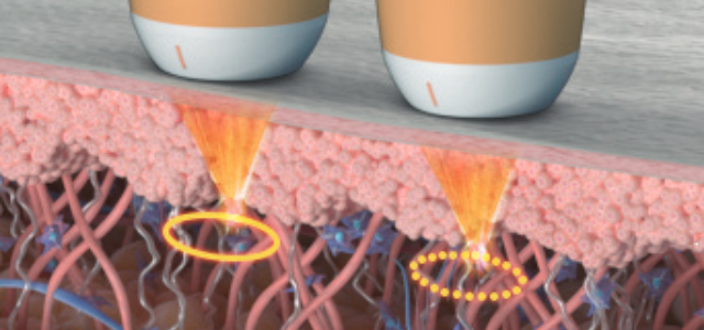 การทำงานของหัวยิง Ultraformer MPT เพื่อยกกระชับหน้า