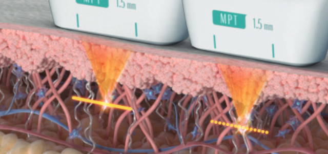 การทำงานของ Ultraformer MPT