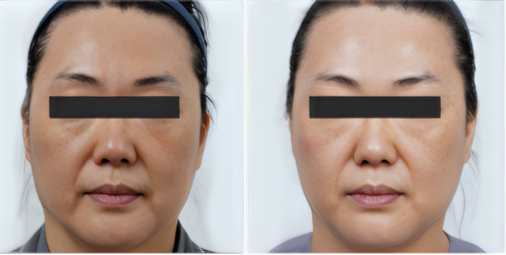 รีวิวยกกระชับหน้า ด้วย ultraformer mpt