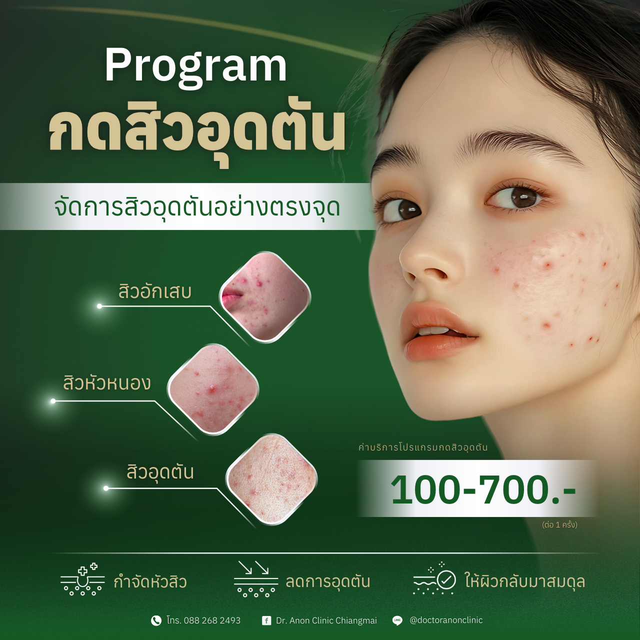 โปรแกรมกดสิวอุดตัน เชียงใหม่
