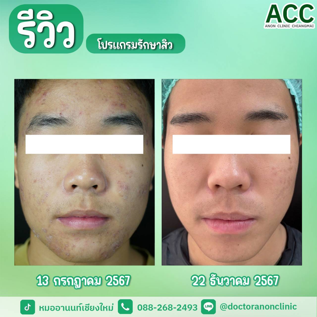 โปรแกรมรักษาสิวเชียงใหม่ Anon Clinic