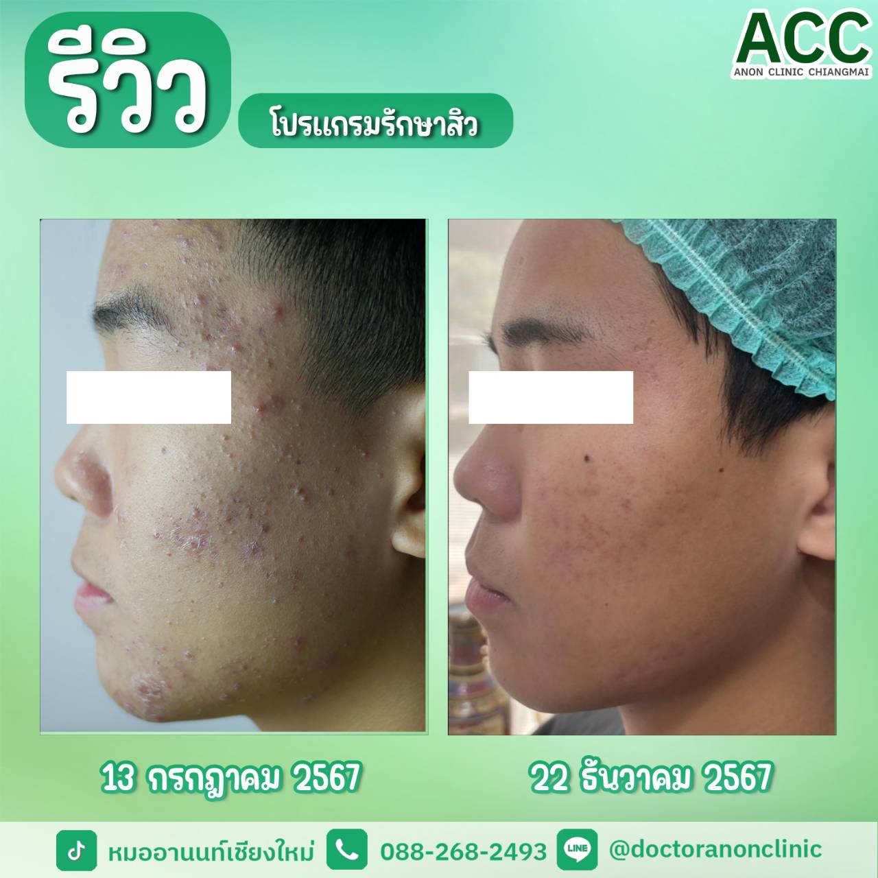 รีวิวโปรแกรมรักษาสิวจากผู้ใช้บริการ คลินิกรักษาสิวเชียงใหม่