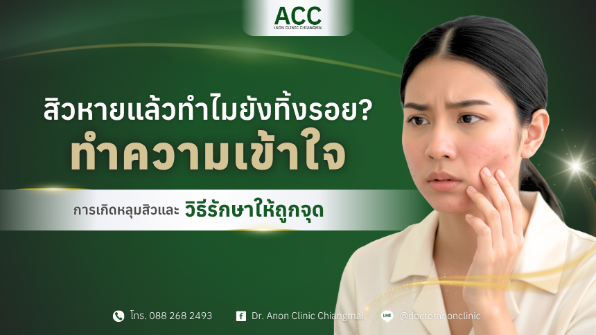 การเกิดหลุมสิวและวิธีรักษา