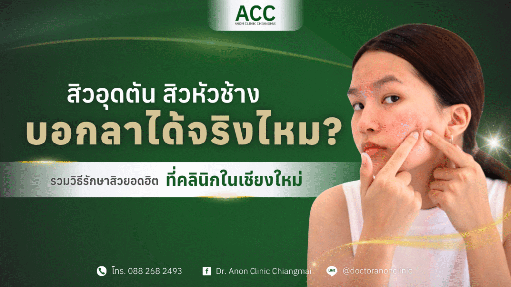 รักษาสิวอุดตัน เชียงใหม่