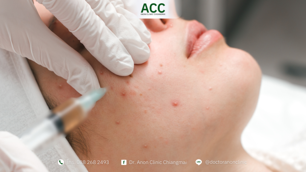 ฉีดสิว เชียงใหม่