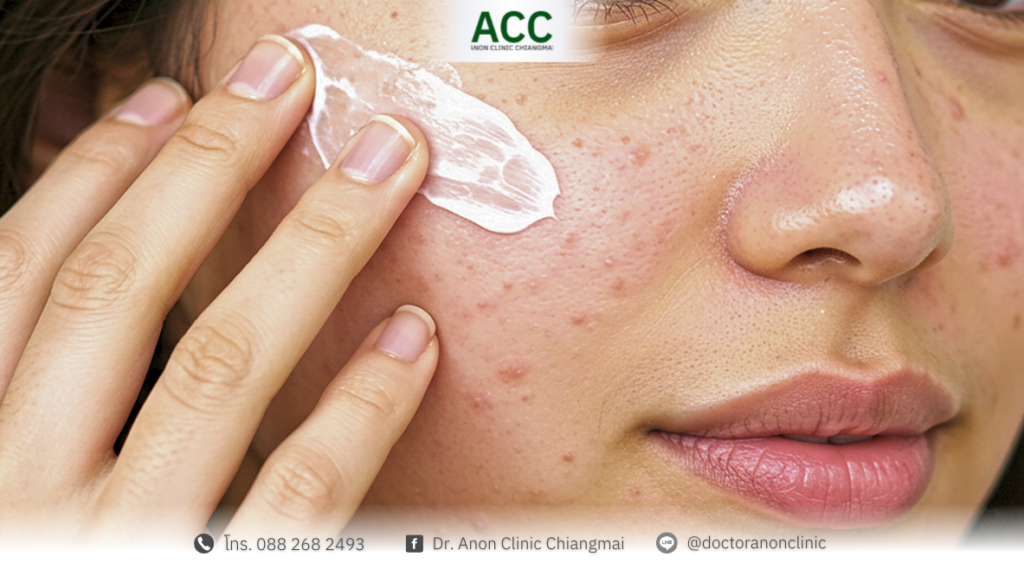 ครีมแต้มมสิว