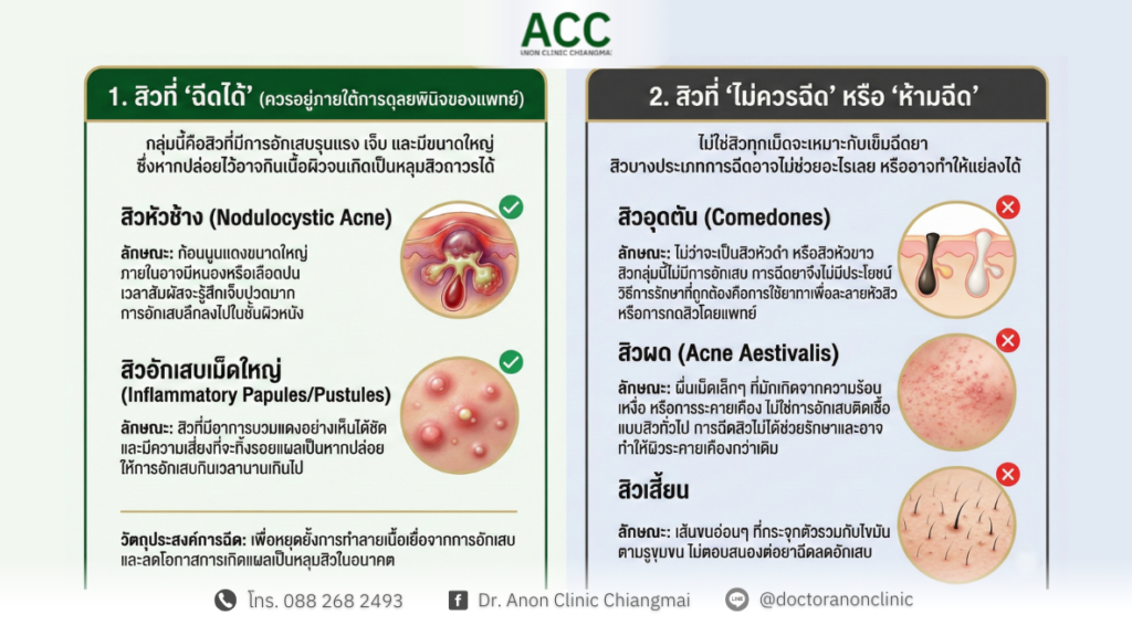 สิวแบบไหนที่ฉีดได้ แบบไหนที่ห้ามฉีด