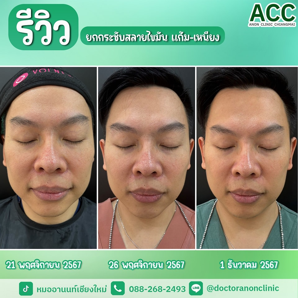 ผลลัพธ์ยกกระชับหน้าเชียงใหม่