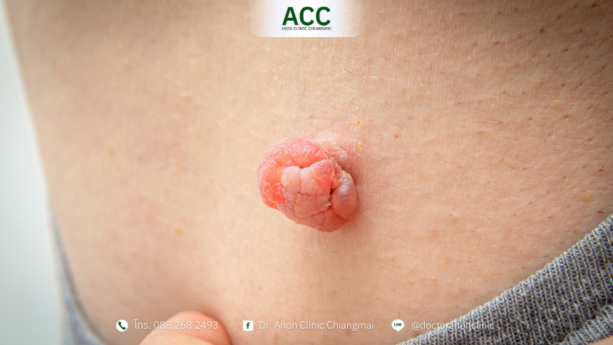 Skin tags vs warts-1