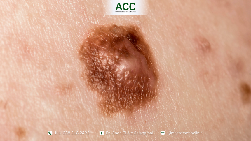 Skin tags vs warts-2