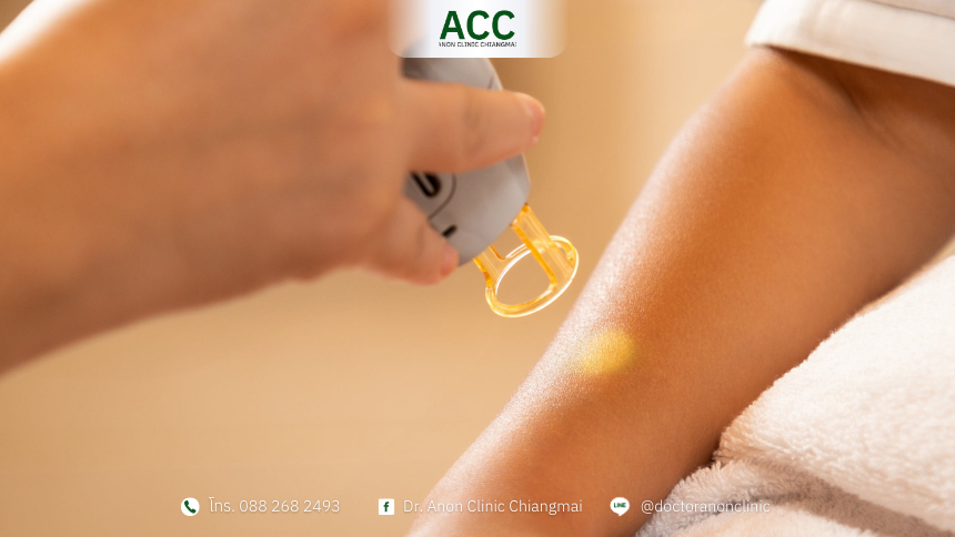 Skin tags vs warts-3