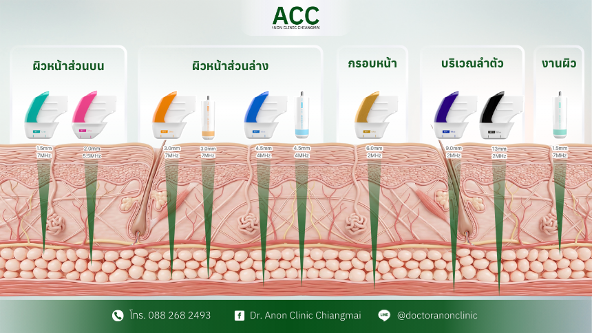 ultraformer-mpt-smas-layer-anatomy-tips-1