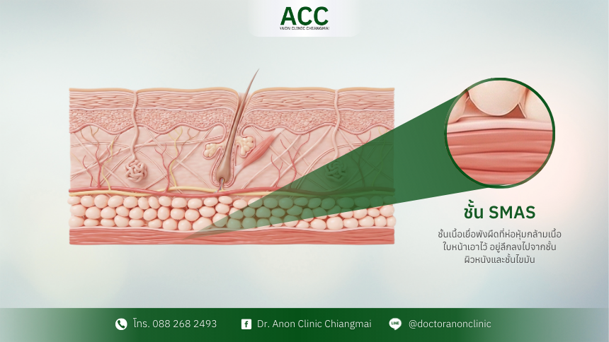 ultraformer-mpt-smas-layer-anatomy-tips-2